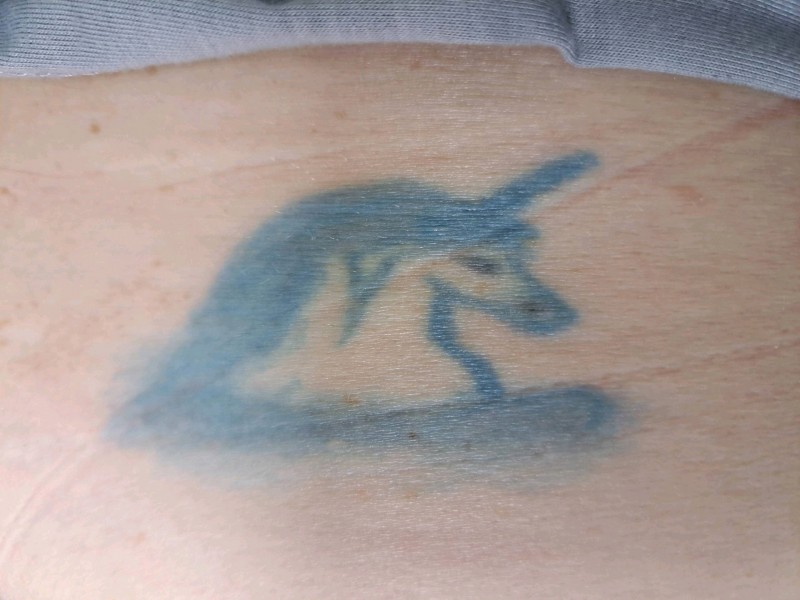 Effacement progressif d'un ancien tatouage sur le corps à Sanguinet 