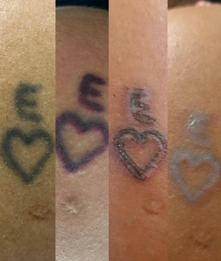 Effacement progressif d'un ancien tatouage à Sanguinet près du Bassin d'Arcachon